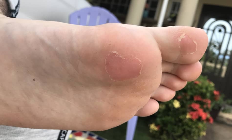 stop blisters on back of heel